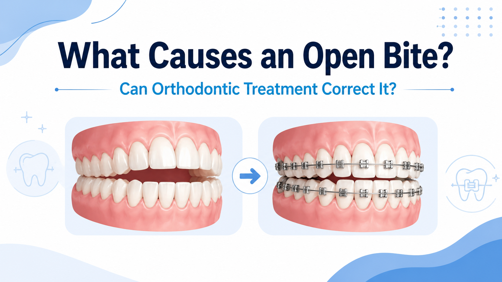 What Causes an Open Bite, and Can Orthodontic Treatment Correct It?